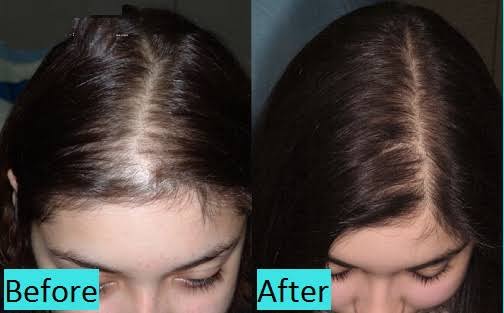 eDermaStamp Hair Growth Treatment