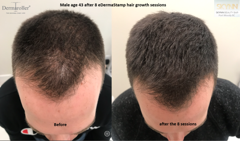 eDermaStamp Hair Growth After 8 sessions