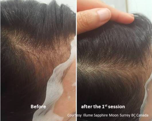 eDermaStamp Hair Growth After 1 session